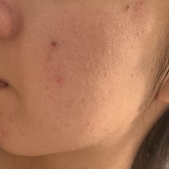 Pure Skin Lounge - Before - Skin Care Near Me - San Diego, California Pure Skin Lounge - Before - Skin Care Near Me - San Diego, California