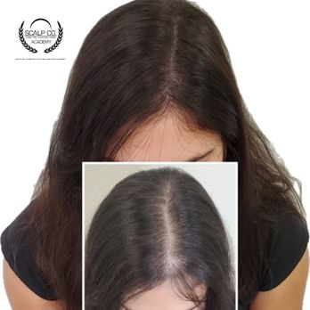 Scalp Co - Scalp Micro Pigmentation - Hair Loss Centers Near Me - Sacramento, California Scalp Co - Scalp Micro Pigmentation - Hair Loss Centers Near Me - Sacramento, California
