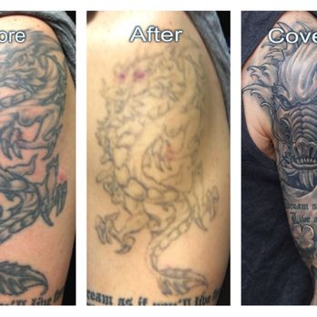 Rethink Your Ink - Check out this awesome transformation! - Tattoo Removal Near Me - Honolulu, Hawaii Rethink Your Ink - Check out this awesome transformation! - Tattoo Removal Near Me - Honolulu, Hawaii