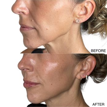 Love + Roots - Sofwave Lifting + Tightening treatment - before and after results of lower face (left side) after one treatment. - Hair Salons Near Me - Austin, Texas