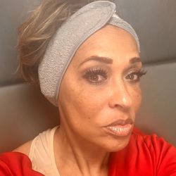 Skindulgence Medspa - Me 24 hours after