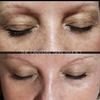 The Esthetics Bar - Opti Resurfacing Treatment with Corium Corrective Serum. - Skin Care Near Me - Clayton, North Carolina The Esthetics Bar - Opti Resurfacing Treatment with Corium Corrective Serum. - Skin Care Near Me - Clayton, North Carolina