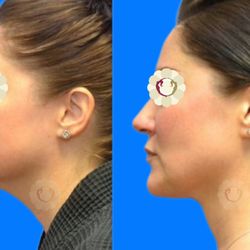 Georgia Plastic & Reconstructive Surgery - Neck Contouring with Lipo, skin tightening, & Y-Lift by Dr Okoro