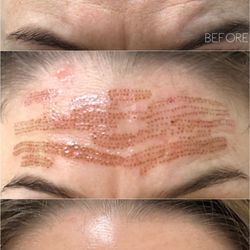 MPi Clinic - Plasma Skin tightening on forehead to reduce wrinkles naturally