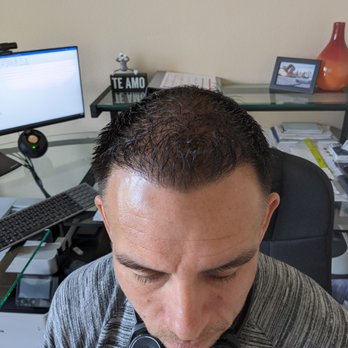 DHI Mexico - This is month 6 after procedure - Hair Loss Centers Near Me - Tijuana, BCN