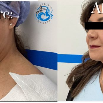 Rivertown Med Spa - FaceTite Procedure ( Scarless Face Lift) Before and After - Medical Spas Near Me - Sleepy Hollow, New York Rivertown Med Spa - FaceTite Procedure ( Scarless Face Lift) Before and After - Medical Spas Near Me - Sleepy Hollow, New York