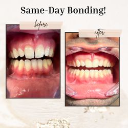Mojgan Shokri, DDS - Mega Bite Dental - Same-Day Bonding Procedure!
Book your appointment today!