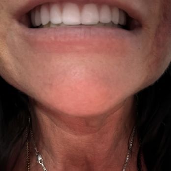 Bionic Smile - I loved my experience,Everybody was top notch again if you're thinking about it, don't wait do it! Oh, and the price is Great! - Cosmetic Dentists Near Me - Las Vegas, Nevada Bionic Smile - I loved my experience,Everybody was top notch again if you're thinking about it, don't wait do it! Oh, and the price is Great! - Cosmetic Dentists Near Me - Las Vegas, Nevada