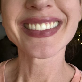 Daybreak Dental - After Invisalign treatment - Endodontists Near Me - Battle Ground, Washington Daybreak Dental - After Invisalign treatment - Endodontists Near Me - Battle Ground, Washington