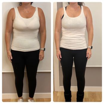 IV Lounge - Before and After Semaglutide Weight-loss injections - Medical Spas Near Me - South Windsor, Connecticut