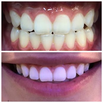 MySmile - Before and after 3 - Medical Spas Near Me - Houston, Texas MySmile - Before and after 3 - Medical Spas Near Me - Houston, Texas