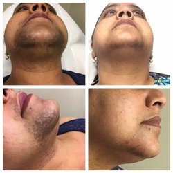 Radiant You Aesthetics - Left photos are before Laser Hair Removal. Photos to the right show improvement after only 2 treatments. Client needs 4 more treatments.