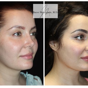 Moelleken Plastic Surgery - Reconstructive Fat transfer to lips and nasolabial folds, pinched nose correction, lip lift, neck lipo & necklace, hairline reshaping - Cosmetic Surgeons Near Me - Beverly Hills, California Moelleken Plastic Surgery - Reconstructive Fat transfer to lips and nasolabial folds, pinched nose correction, lip lift, neck lipo & necklace, hairline reshaping - Cosmetic Surgeons Near Me - Beverly Hills, California