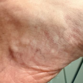 Bates Mill Dermatology - I had no idea what was happening on my skin, but obviously something is. Epic fail for both Dr. Bouman and Matt. - Dermatologists Near Me - Lewiston, Maine Bates Mill Dermatology - I had no idea what was happening on my skin, but obviously something is. Epic fail for both Dr. Bouman and Matt. - Dermatologists Near Me - Lewiston, Maine