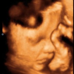 Peekme 3D/4D Ultrasounds
