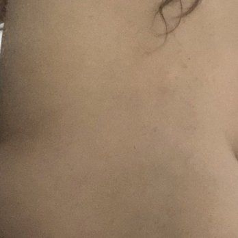 Relaxing Station Spa - My back, all along my spine. Look at the green bruising - Massage Near Me - Antioch, California Relaxing Station Spa - My back, all along my spine. Look at the green bruising - Massage Near Me - Antioch, California