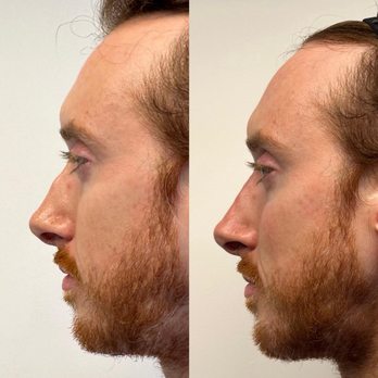 Skin Muse MD - Male non-surgical rhinoplasty - Medical Spas Near Me - New York, New York Skin Muse MD - Male non-surgical rhinoplasty - Medical Spas Near Me - New York, New York