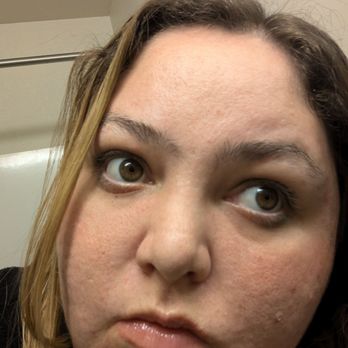 SkinSpirit - Willow Glen - My skin before chemical peels - Skin Care Near Me - San Jose, California SkinSpirit - Willow Glen - My skin before chemical peels - Skin Care Near Me - San Jose, California