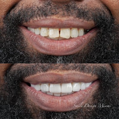 Porcelain Smile Makeover - Comprehensive Dental Restoration
Restorative dentistry focuses on repairing or replacing teeth that are damaged, decayed, or missing. At Smile Design Miami, our restoration services combine advanced techniques and high-quality materials to restore your teeth's function and appearance.
Our comprehensive restorative services include:
Tooth-colored fillings for cavity repair
Custom-crafted dental crowns and bridges
Inlays and onlays for moderate tooth damage
Dentures and partial dentures
Root canal therapy for infected teeth
Dental implant restorations
Tooth-Colored Fillings
Natural-looking composite resin fillings that match your tooth color while effectively treating cavities or replacing old, failing metal fillings.
Aesthetically pleasing and discreet
Mercury-free and biocompatible
Preserves more natural tooth structure
Dental Crowns
Custom-made caps that cover and protect damaged or weakened teeth while restoring their shape, size, strength, and appearance.
Full protection for damaged teeth
Available in all-ceramic or porcelain-fused-to-metal
Long-lasting restoration solution
Dental Bridges
Fixed prosthetic devices that "bridge" the gap created by one or more missing teeth, anchored to the natural teeth or implants on either side of the gap.
Restores your smile and ability to chew properly
Maintains face shape and prevents remaining teeth from drifting
Fixed solution (non-removable)
Inlays & Onlays
Custom-made restorations for teeth with moderate damage or decay that's too extensive for a filling but doesn't require a full crown.
Preserves more natural tooth structure than crowns
Made from durable porcelain or composite materials
Strengthens the tooth's structure and prevents further damage
Dentures
Removable appliances that replace missing teeth and surrounding tissues, available as complete dentures (all teeth) or partial dentures (some natural teeth remain).
Improves speech, eating ability, and facial appearance
Modern materials provide a natural-looking appearance
Option for implant-supported dentures available for greater stability
Root Canal Therapy
Treatment to save and repair an infected or severely damaged tooth by removing the infected pulp, cleaning and disinfecting the inside, then filling and sealing it.
Preserves your natural tooth
Eliminates pain from infected or inflamed pulp
Modern techniques make the procedure comfortable Porcelain Smile Makeover - Comprehensive Dental Restoration
Restorative dentistry focuses on repairing or replacing teeth that are damaged, decayed, or missing. At Smile Design Miami, our restoration services combine advanced techniques and high-quality materials to restore your teeth's function and appearance.
Our comprehensive restorative services include:
Tooth-colored fillings for cavity repair
Custom-crafted dental crowns and bridges
Inlays and onlays for moderate tooth damage
Dentures and partial dentures
Root canal therapy for infected teeth
Dental implant restorations
Tooth-Colored Fillings
Natural-looking composite resin fillings that match your tooth color while effectively treating cavities or replacing old, failing metal fillings.
Aesthetically pleasing and discreet
Mercury-free and biocompatible
Preserves more natural tooth structure
Dental Crowns
Custom-made caps that cover and protect damaged or weakened teeth while restoring their shape, size, strength, and appearance.
Full protection for damaged teeth
Available in all-ceramic or porcelain-fused-to-metal
Long-lasting restoration solution
Dental Bridges
Fixed prosthetic devices that "bridge" the gap created by one or more missing teeth, anchored to the natural teeth or implants on either side of the gap.
Restores your smile and ability to chew properly
Maintains face shape and prevents remaining teeth from drifting
Fixed solution (non-removable)
Inlays & Onlays
Custom-made restorations for teeth with moderate damage or decay that's too extensive for a filling but doesn't require a full crown.
Preserves more natural tooth structure than crowns
Made from durable porcelain or composite materials
Strengthens the tooth's structure and prevents further damage
Dentures
Removable appliances that replace missing teeth and surrounding tissues, available as complete dentures (all teeth) or partial dentures (some natural teeth remain).
Improves speech, eating ability, and facial appearance
Modern materials provide a natural-looking appearance
Option for implant-supported dentures available for greater stability
Root Canal Therapy
Treatment to save and repair an infected or severely damaged tooth by removing the infected pulp, cleaning and disinfecting the inside, then filling and sealing it.
Preserves your natural tooth
Eliminates pain from infected or inflamed pulp
Modern techniques make the procedure comfortable