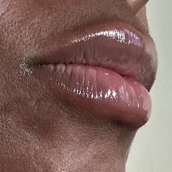 Vanity Skin Bar - Lip flip with first time lip, filler, one syringe of lip filler - Medical Spas Near Me - Baltimore, Maryland