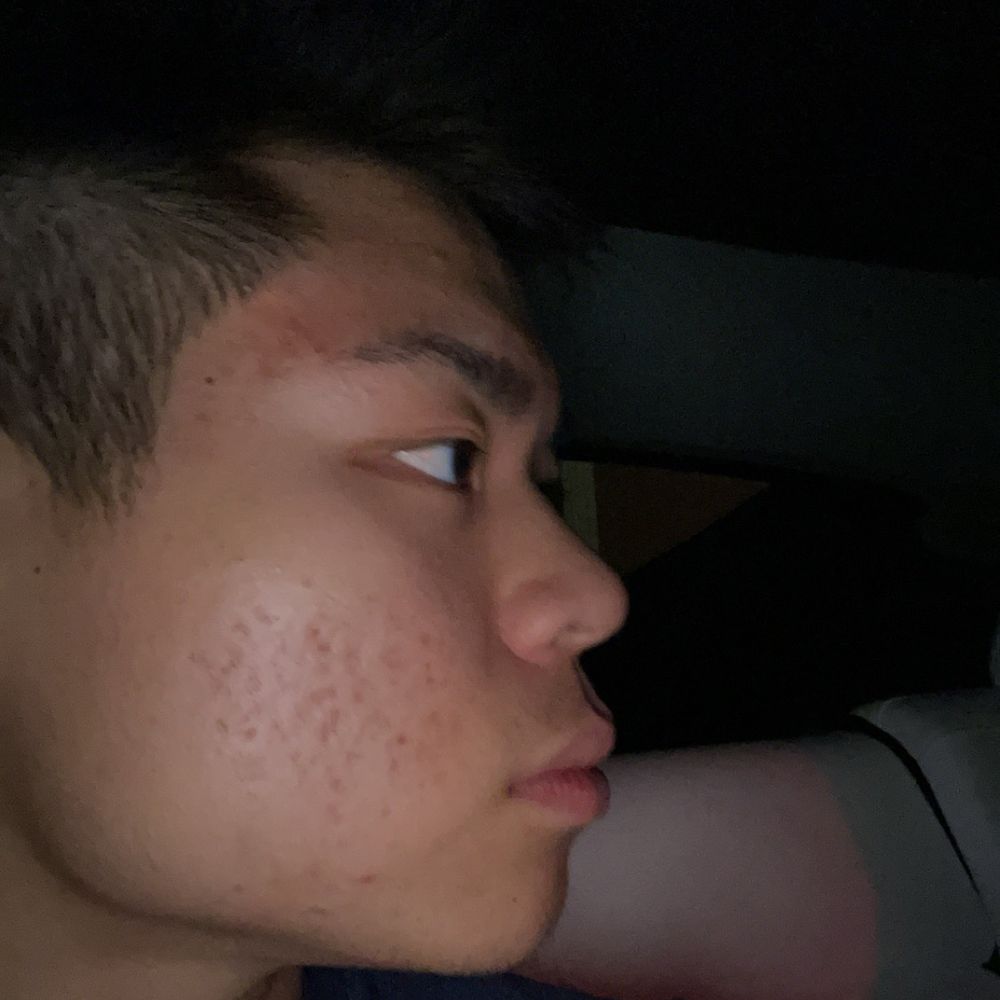 Bespoke Wellness & Acupuncture - after ONLY 2 treatments. Minimal active acne, only acne scars and hyperpigmentation. - Acupuncture Near Me - Arcadia, California