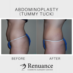Brian Eichenberg, MD - Tummy Tuck at Renuance Cosmetic Surgery Center & Medical Spa in Murrieta, CA