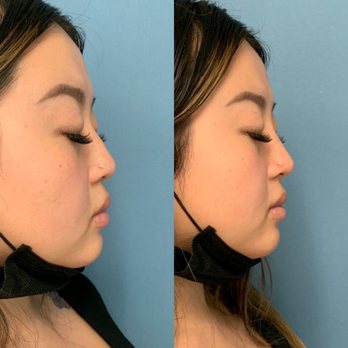 The Image Center - Nose filler before and after - Plastic Surgeons Near Me - Irvine, California The Image Center - Nose filler before and after - Plastic Surgeons Near Me - Irvine, California