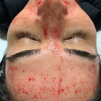 Encore Medspa - Microneedling by the FDA approved SkinPen can dramatically improve skin texture, acne scarring, fine lines and more! - Laser Hair Removal Near Me - Walnut Creek, California