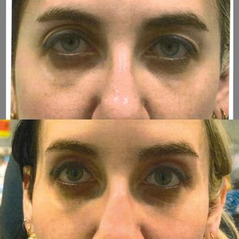 Yao Wang, MD - Eyesthetica - Before and after photos of my eyelids taken in office - Ophthalmologists Near Me - Encino, California