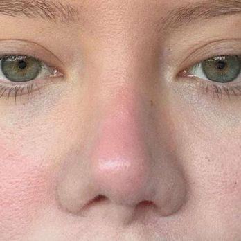 Sozer Sadri, MD - Final result - Cosmetic Surgeons Near Me - El Paso, Texas Sozer Sadri, MD - Final result - Cosmetic Surgeons Near Me - El Paso, Texas