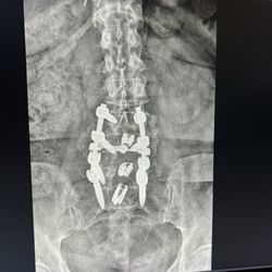 Align Spine Center - Fusion