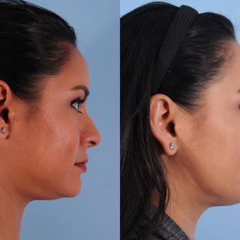 Appearance Care Center - Ultherapy! No Downtime with this amazing laser treatment. - Laser Hair Removal Near Me - San Francisco, California Appearance Care Center - Ultherapy! No Downtime with this amazing laser treatment. - Laser Hair Removal Near Me - San Francisco, California