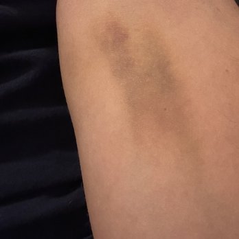 Labcorp - My arm eight days after having a routine blood draw at this LabCorp location. - Laboratory Testing Near Me - Chino, California Labcorp - My arm eight days after having a routine blood draw at this LabCorp location. - Laboratory Testing Near Me - Chino, California