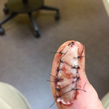 Avalon Health - 14 stitches later. - Internal Medicine Near Me - Savannah, Georgia Avalon Health - 14 stitches later. - Internal Medicine Near Me - Savannah, Georgia