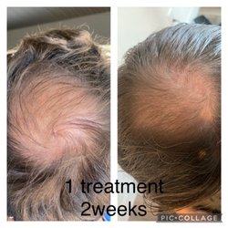 PC Skin Expert - Before and after Hair rejuvenation (microneedlng)