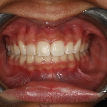 Grace H Cho, DDS - AFTER - Periodontists Near Me - Panorama City, California Grace H Cho, DDS - AFTER - Periodontists Near Me - Panorama City, California