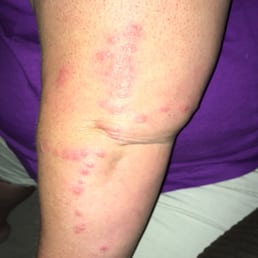 Bed bug bites!!!