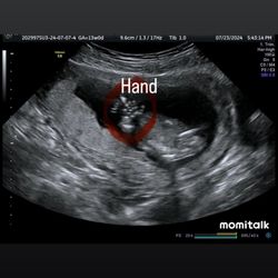 Ultrasound Studio - Baby hand