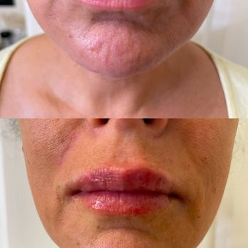 Oasis Aesthetics - "M" lip filler - Weight Loss Centers Near Me - Riverside, California Oasis Aesthetics - "M" lip filler - Weight Loss Centers Near Me - Riverside, California