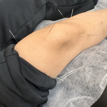 Tensegrity Acupuncture - Acupuncture Near Me - Las Vegas, Nevada Tensegrity Acupuncture - Acupuncture Near Me - Las Vegas, Nevada