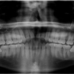 Flores Dental PH - Did surgical removal of impacted 3rd molars of my patient,who is only 16 years old. Will do the other side next time after complete healing.