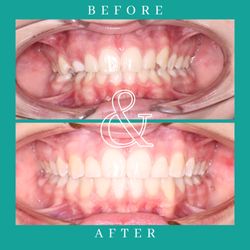 Weber Orthodontics - Before and After Braces