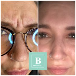 Beautytox Aesthetics - Smooth out this beautiful client's frown lines in less then 2 weeks!