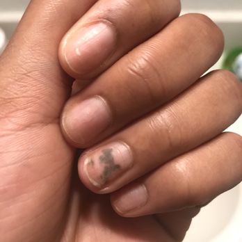 Rico Nail - What my nails looked like after taking off the acrylic - Nail Salons Near Me - Smyrna, Georgia Rico Nail - What my nails looked like after taking off the acrylic - Nail Salons Near Me - Smyrna, Georgia