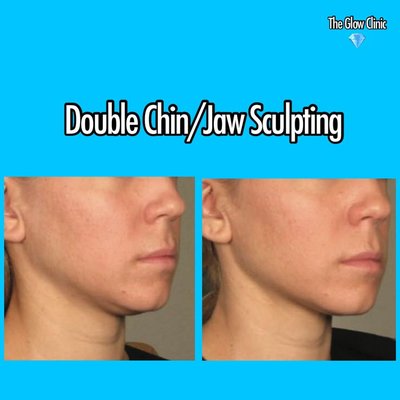 Face & Neck Transformations - Examples of face and neck transformations done for patients. Face & Neck Transformations - Examples of face and neck transformations done for patients.