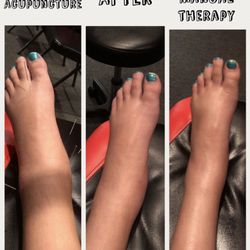 HomeTown Health & Wellness - Results after 1 treatment with Dr. Ryan. This athlete walked out of our office on this ankle the first day!!