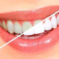 MKS Dental - Teeth Whitening