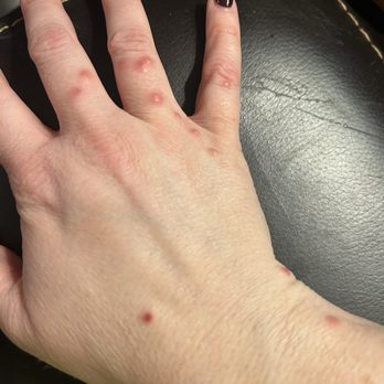 Great Wolf Lodge - Bed bug bites - Resorts Near Me - Scotrun, Pennsylvania
