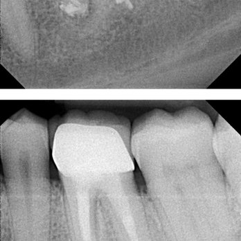 Alderwood Endodontics - Here is 2.5 months later :D the tooth is healing very nicely and no more infection :) Operation save my tooth a success - Endodontists Near Me - Lynnwood, Washington Alderwood Endodontics - Here is 2.5 months later :D the tooth is healing very nicely and no more infection :) Operation save my tooth a success - Endodontists Near Me - Lynnwood, Washington