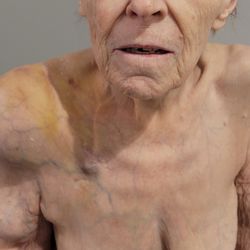 Ridgecrest of McCandless - Broken shoulder neglected